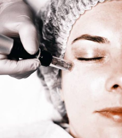 microneedling